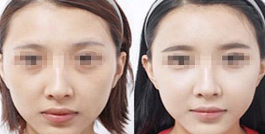 邯鄲哪家醫(yī)院做乳房整形效果好？