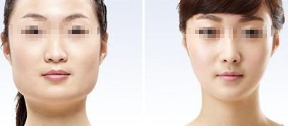 咸陽哪家醫(yī)院做雙眼皮好？醫(yī)院推薦！