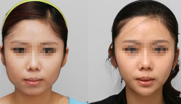 鷹鉤鼻矯正費(fèi)用分析：價格大揭秘