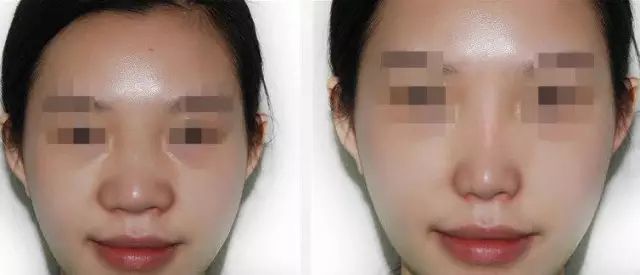 哈爾濱哪家醫(yī)院做隆鼻好？醫(yī)療技術(shù)排行幫你快速選擇