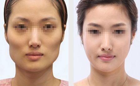 深圳隆胸醫(yī)院推薦：專業(yè)經(jīng)驗(yàn)豐富、口碑好的醫(yī)院