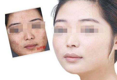 廣州肚皮上的妊娠紋如何有效修復？