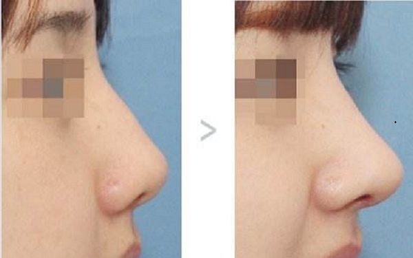 青島哪家下頜角整形醫(yī)院口碑好？