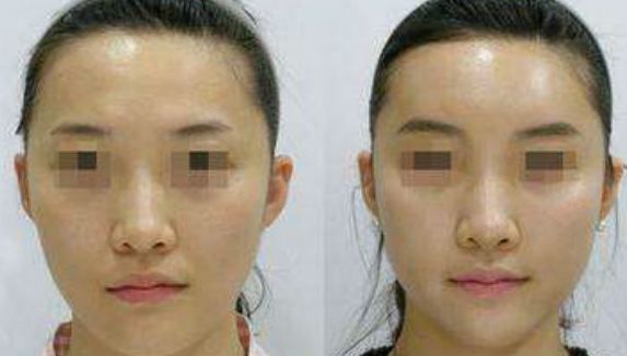 溫建民拇指外翻手術(shù)費用實惠，術(shù)前術(shù)后效果一流