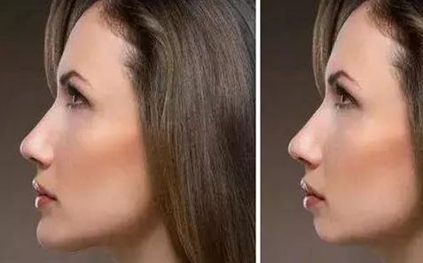 成都哪家醫(yī)院的肋骨鼻修復效果好？推薦幾位專業(yè)的鼻修復醫(yī)生