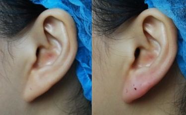 福州美貝爾葉森明吸脂口碑如何？術(shù)后效果真有傳聞那么好嗎