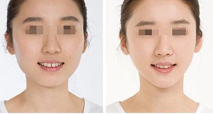 杭州治療鼻骨骨折的醫(yī)院推薦