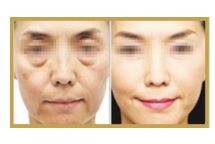 日照哪家醫(yī)院做雙眼皮手術(shù)技術(shù)高效？