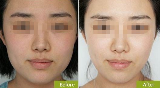 杭州哪家醫(yī)院能夠安全而有效地進(jìn)行隱形矯正？