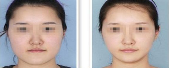 福州吸脂手術(shù)哪家醫(yī)院技術(shù)先進(jìn)受用戶好評