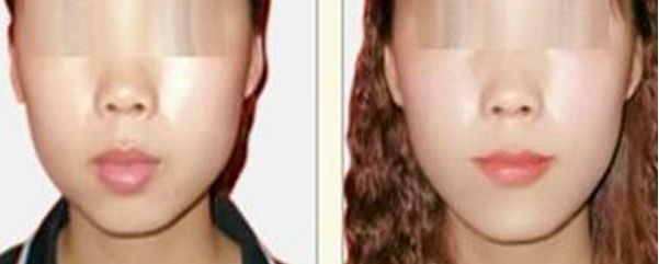 南寧愛爾眼科近視手術(shù)費詳解及醫(yī)生團隊