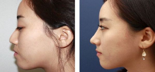 北京大腿抽脂專家推薦，哪個(gè)醫(yī)院技術(shù)好？