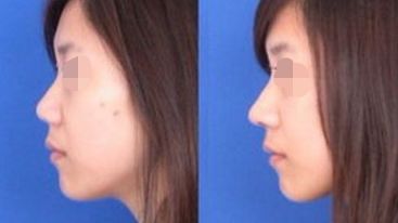 2024年長沙權(quán)威整形醫(yī)院指南：隆鼻選亞韓，隆胸選do胸