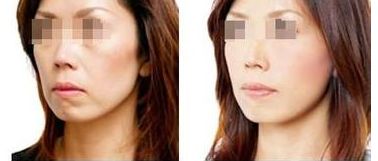 2024珠海雙眼皮手術(shù)醫(yī)院推薦，幫您預(yù)測(cè)前五家