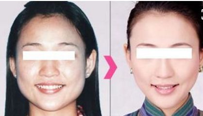 貴陽(yáng)哪家醫(yī)院做自體脂肪豐蘋(píng)果肌比較好