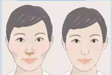 雙眼皮術(shù)后護(hù)理全攻略：埋線和全切有何異同？多久恢復(fù)自然？