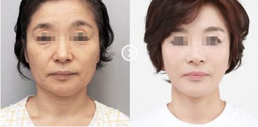 蘇州奧克拉醫(yī)院的整形效果及評(píng)價(jià)如何？