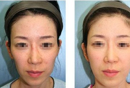 沈陽鼻整形醫(yī)院排名前5，專家推薦！