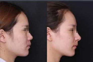 寧波哪家醫(yī)院做隆鼻手術(shù)效果好？