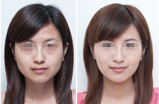 合肥哪家雙眼皮修復(fù)效果好？排名前十的整形醫(yī)院大揭秘