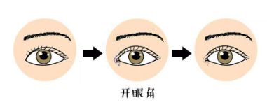 如何選擇適合自己的雙眼皮手術(shù)方法？