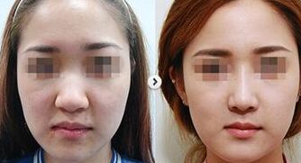 上海愛爾眼科醫(yī)院近視眼視力矯正方案解析：技術(shù)、價格、醫(yī)生介紹全攻略