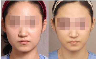 蘭州鼻子整形效果如何？