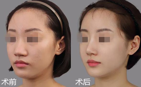 江門哪家醫(yī)院割雙眼皮效果好？