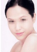 重慶面部脂肪填充專家資深推薦