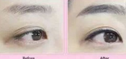 快速消腫！雙下巴吸脂術(shù)后恢復(fù)時(shí)長(zhǎng)揭秘