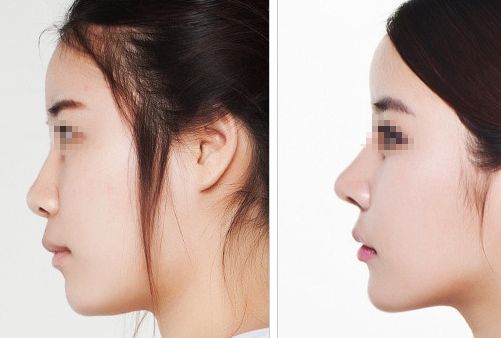 廣東美恩植發(fā)醫(yī)院價(jià)格明細(xì)：2024年最新植眉費(fèi)用單