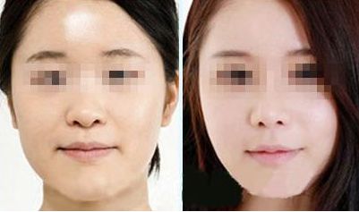 佛山哪家眼部整形醫(yī)院效果好