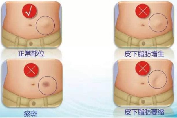 獲悉四川地區(qū)專業(yè)自體脂肪隆胸醫(yī)院，解決您的疑慮