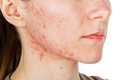 廣州常春藤眼科近視眼矯正：微創(chuàng)全飛秒，15800元起，快速恢復(fù)