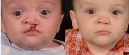 愛美人士必看！艾莉薇PK伊婉玻尿酸，功效、使用范圍、持久度對比