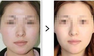 2024東營市哪家醫(yī)院做雙眼皮整形技術(shù)最好