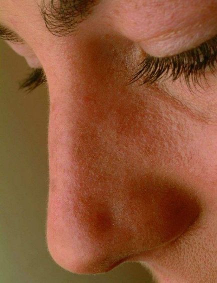 耳部整形術(shù)效果詳解