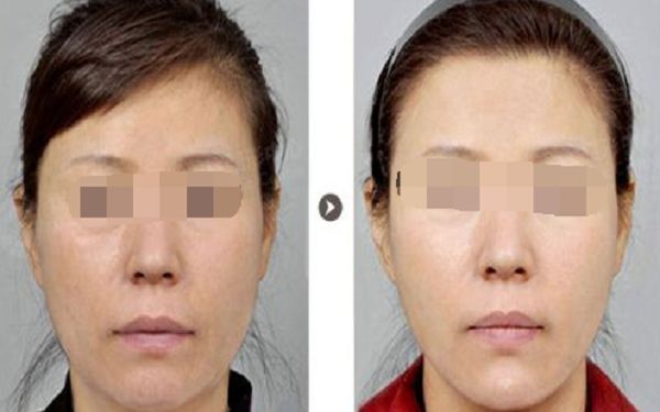 淄博專業(yè)去斑醫(yī)院推薦