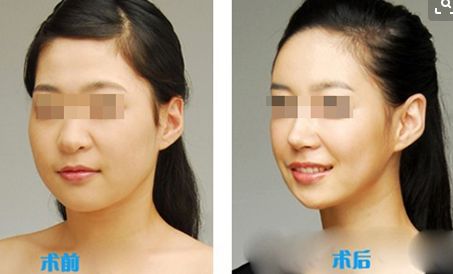 面部脂肪室復(fù)位術(shù)和埋線提升手術(shù)：價(jià)格及區(qū)別比較