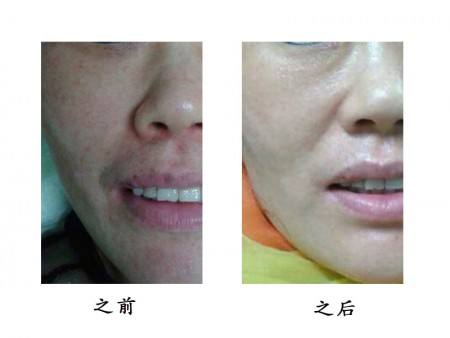 長沙手術(shù)消除妊娠紋醫(yī)生