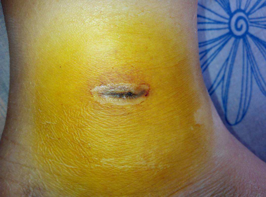 青海胸部脂肪填充醫(yī)生