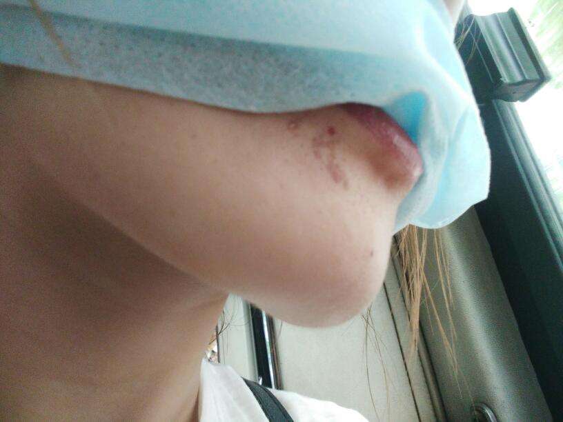 河北鐳射激光開眼角醫(yī)生