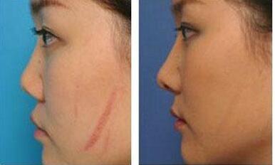 長沙水動(dòng)力吸脂醫(yī)生