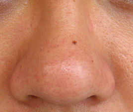 揚(yáng)州真空負(fù)壓去眼袋醫(yī)生