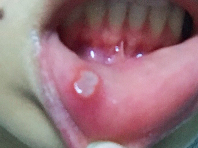 內(nèi)江玻尿酸注射豐唇醫(yī)生