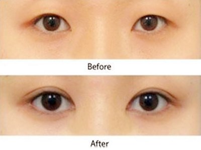 廊坊分層祛痘美膚術(shù)醫(yī)生