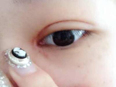 寧波顯微靈動重瞼術(shù)醫(yī)生