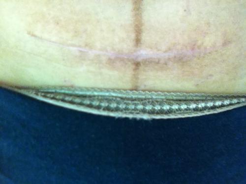 沈陽下巴填充骨膠原醫(yī)生