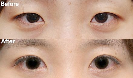 廣州玻尿酸面部皺紋填充醫(yī)生