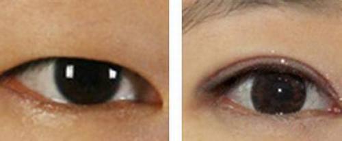 廈門去眼周紋手術醫(yī)生